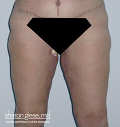 thigh lift after picture